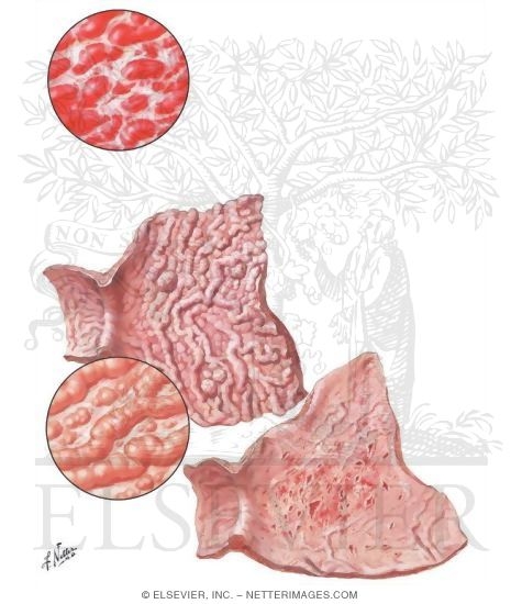 Watermarked preview of unlabeled image: Gastritis