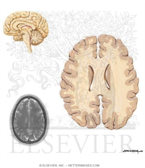 Body of Corpus Callosum
