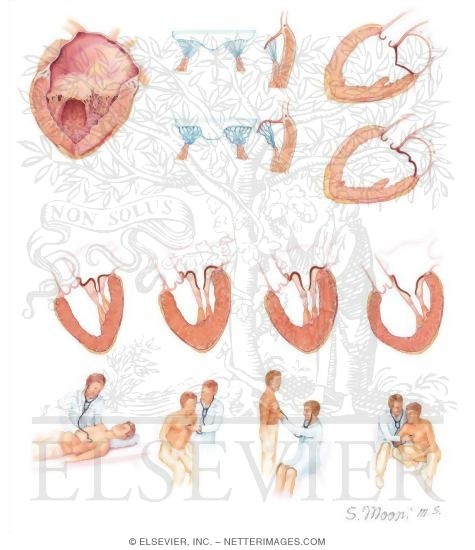 Ausculation In Mitral Valve Prolapse