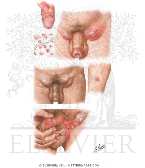 Watermarked preview of unlabeled image: Chancroid, Lymphogranuloma Venereum, and Granuloma Inguinale