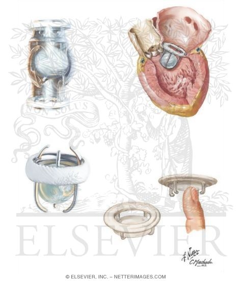 Watermarked preview of unlabeled image: First Generation of Synthetic Prosthetic Valves