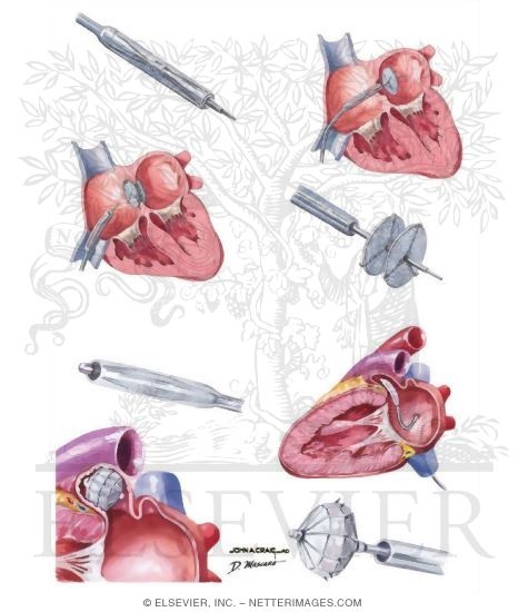Watermarked preview of unlabeled image: Interventional Approaches to Peripheral Arterial Disease