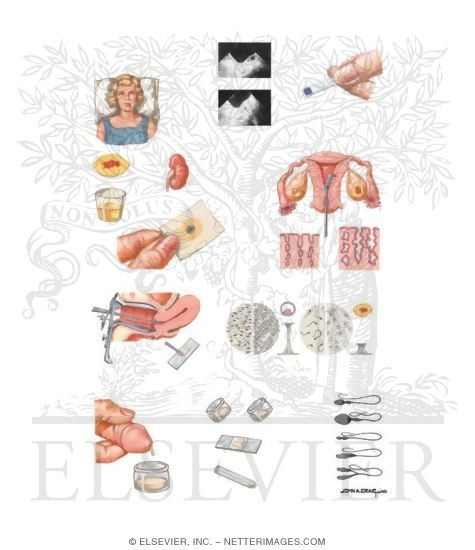 Watermarked preview of unlabeled image: Infertility: General Considerations