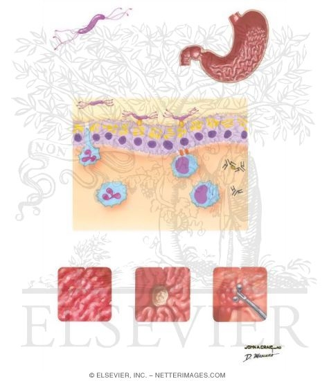 Etiology and Pathogenesis of Helicobacter Pylori Infection