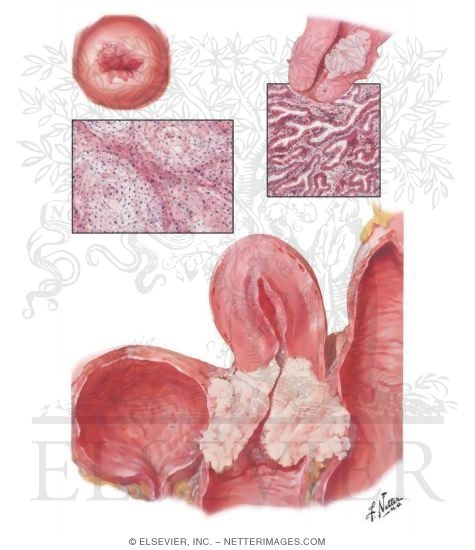 Cervical Cancer