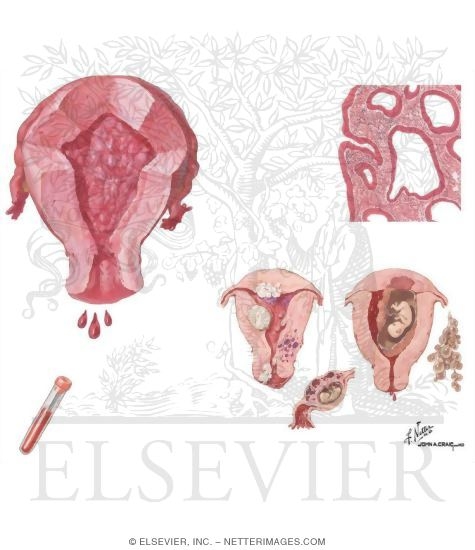Menorrhagia