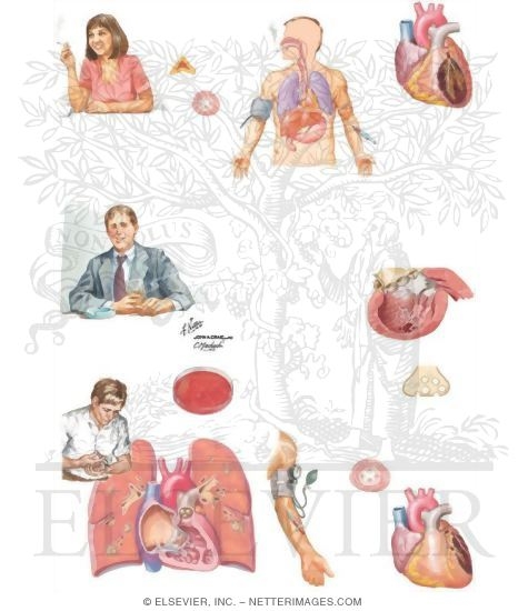 Watermarked preview of unlabeled image: Substance Abuse and the Heart