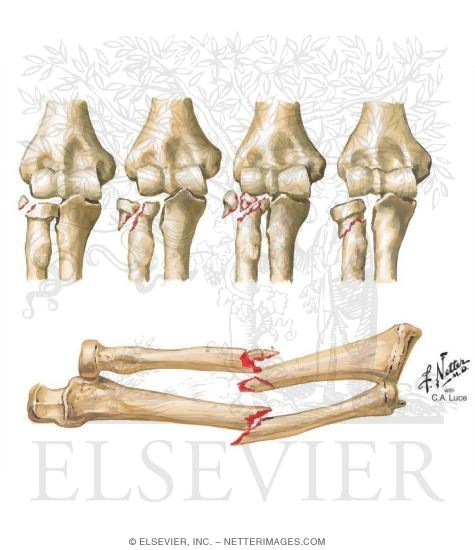 Watermarked preview of unlabeled image: Radial Head Fracture
Fracture of Both Forearm Bones