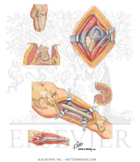 Watermarked preview of unlabeled image: Surgical Approaches to the Thigh and Hip