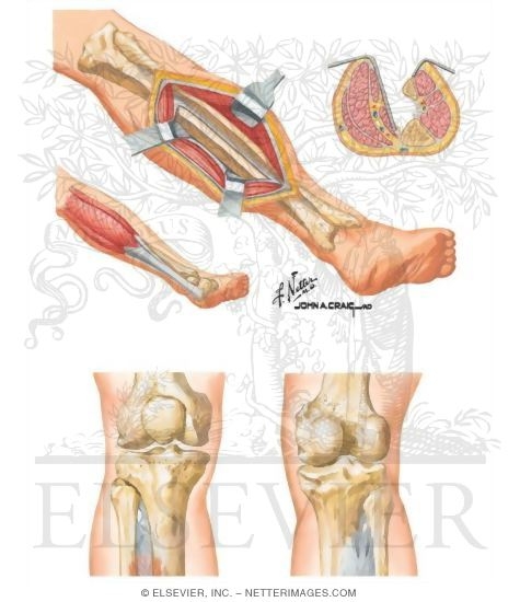 Surgical Approach to the Leg and Knee
Posterolateral Approach to Tibia
Portals for Arthroscopy of Knee