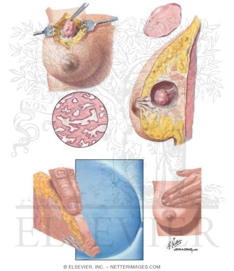 Breast: Fibroadenoma