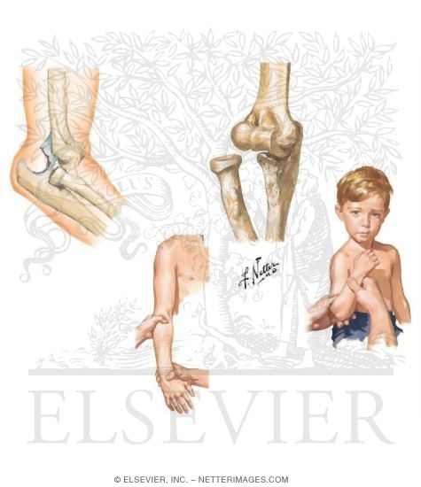 Elbow Dislocation
Radial Head Subluxation