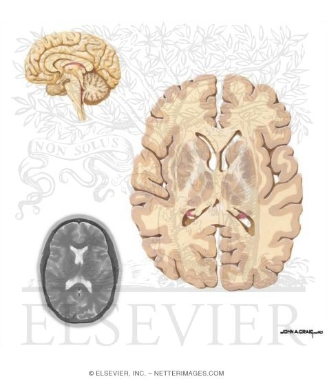 Basal Ganglia and Internal Capsule