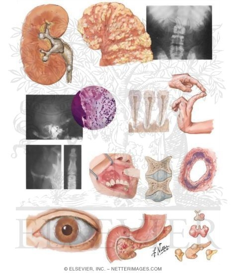 Watermarked preview of unlabeled image: Pathology and Clinical Manifestations of Hyperparathyroidism