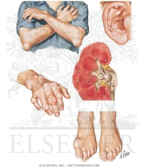 Tophaceous Gout Gouty Arthritis