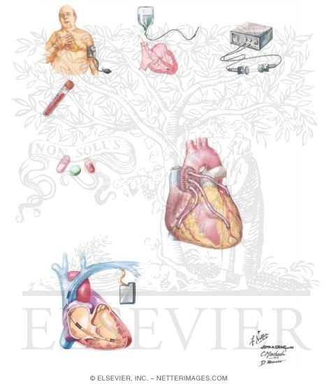 Watermarked preview of unlabeled image: Management of Ventricular Tachycardia