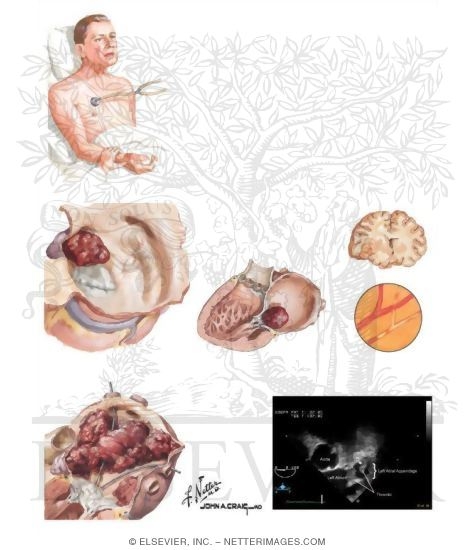 Complications of Atrial Fibrillation