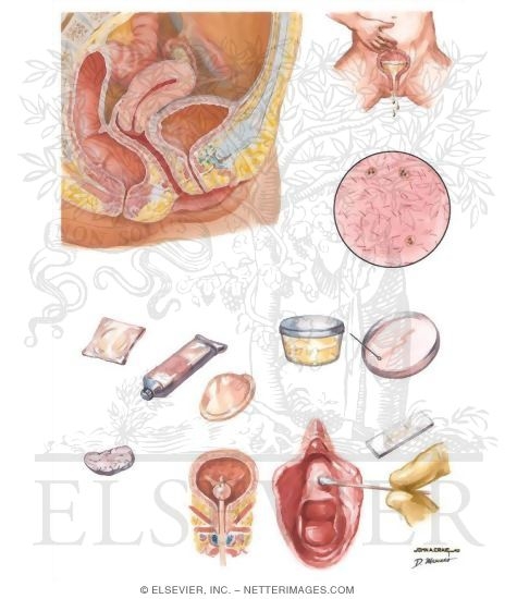 Dysuria