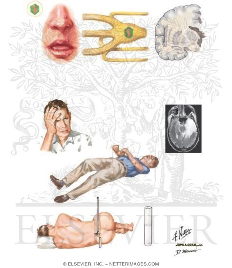 HSV Encephalitis