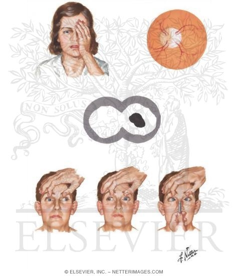 Multiple Sclerosis: Ocular Manifestations of Multiple Sclerosis