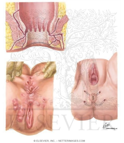 Anorectal Fistula