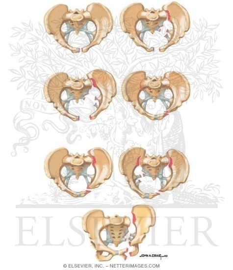 Classification of Pelvic Fractures (Young and Burgess)
Trauma