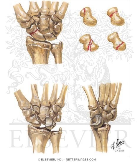 Scaphoid Fracture
Carpal Dislocation