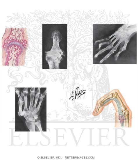 Watermarked preview of unlabeled image: Disorders: Arthritis