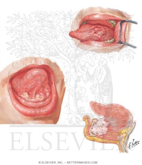 Watermarked preview of unlabeled image: Malignant Tumors of Oral Cavity
