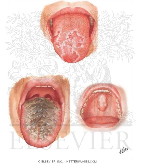 Common Oral Lesions