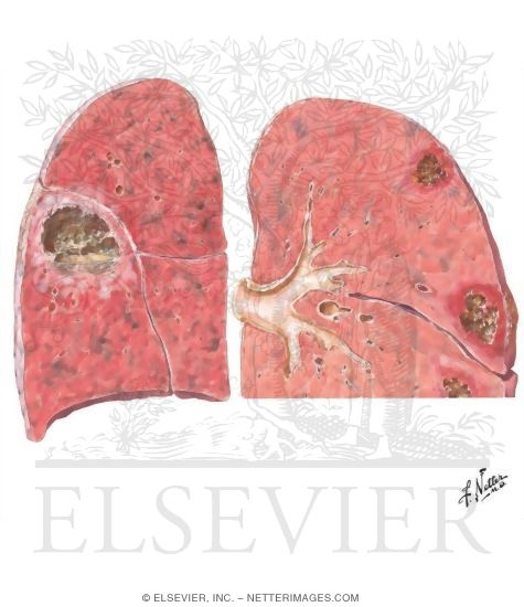 Lung Abscess