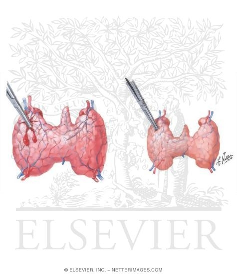 Watermarked preview of unlabeled image: Effects of Therapy in Diffuse Hyperthyroidism (Graves' Disease)