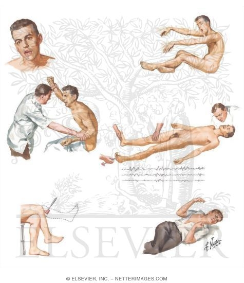 Hepatic Coma