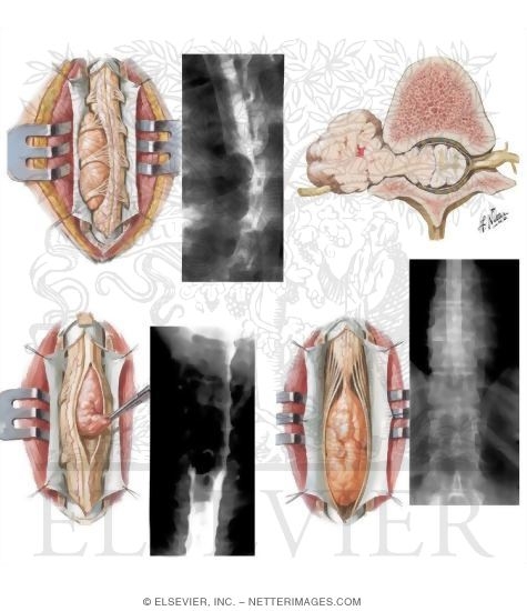 Watermarked preview of unlabeled image: Intradural Spinal Tumors