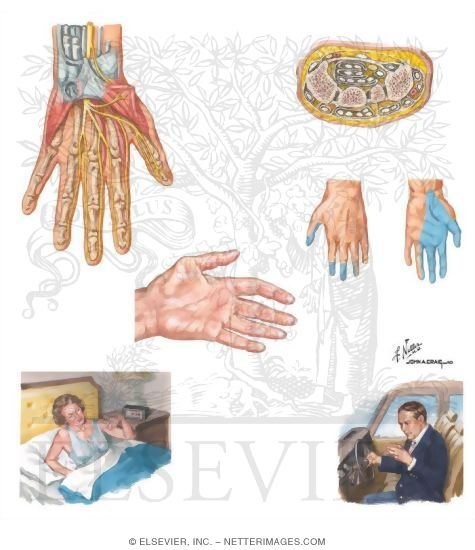 Watermarked preview of unlabeled image: Carpal Tunnel Syndrome