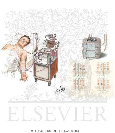 Hemodialysis