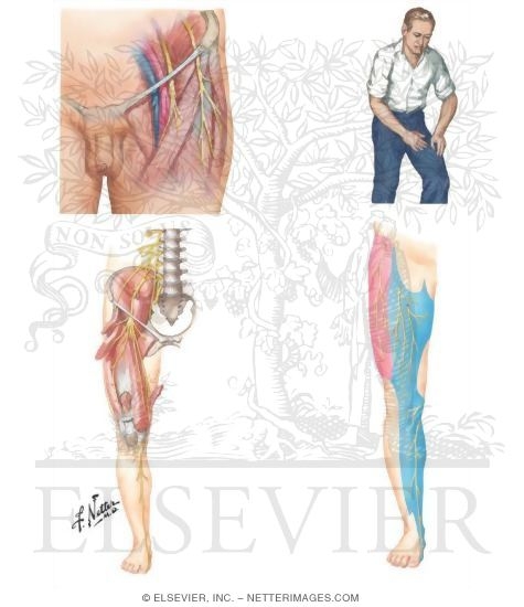 Lateral Femoral Cutaneous Nerve