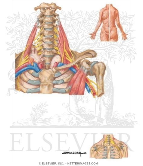 Watermarked preview of unlabeled image: Thoracic Outlet Syndrome: Brachial Plexopathy