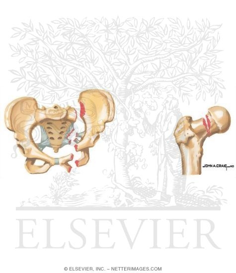 Watermarked preview of unlabeled image: Trauma of the Pelvis