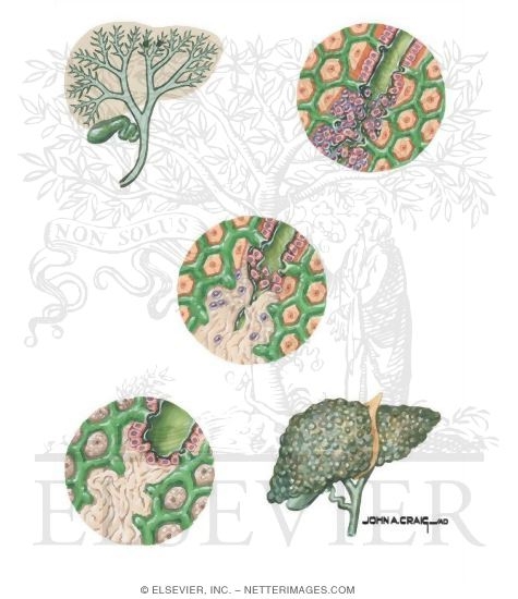 Watermarked preview of unlabeled image: Diseases of the Biliary Tract