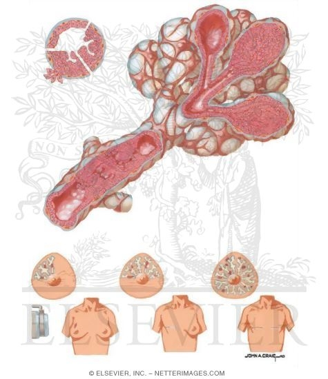 In Situ Carcinomas of Breast (DCIS and LCIS)