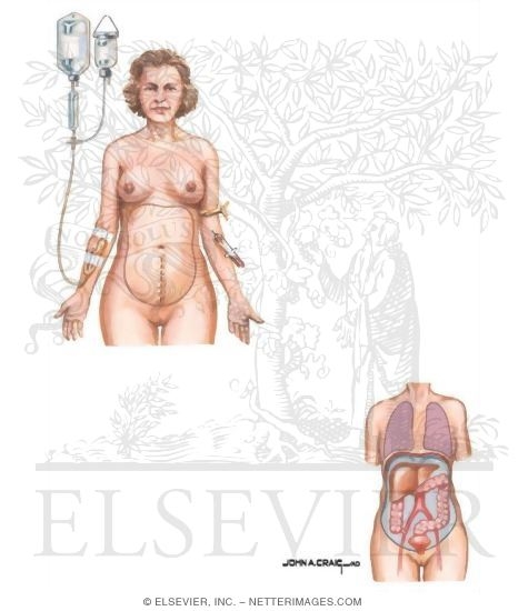 Watermarked preview of unlabeled image: Postoperative Management of Ovarian Cancer
