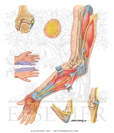 Watermarked preview of unlabeled image: Compression of Ulnar Nerve