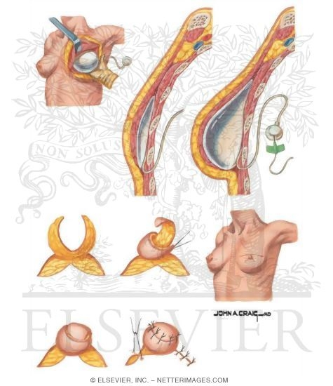 Watermarked preview of unlabeled image: Breast Reconstruction