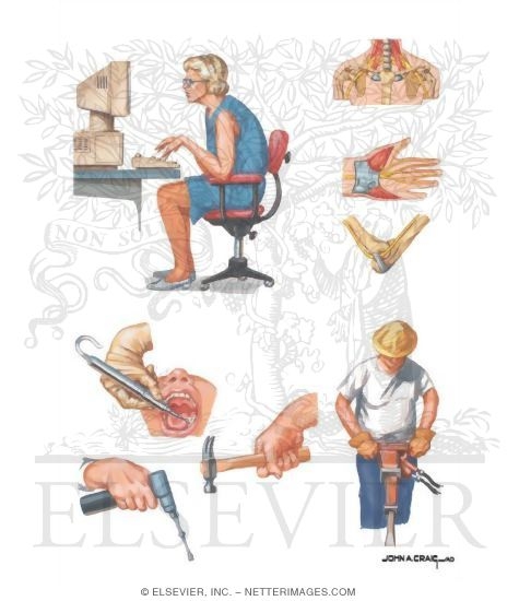 Watermarked preview of unlabeled image: Compression Neuropathy in Workplace