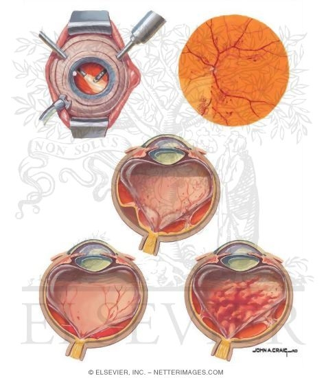 Vitrectomy