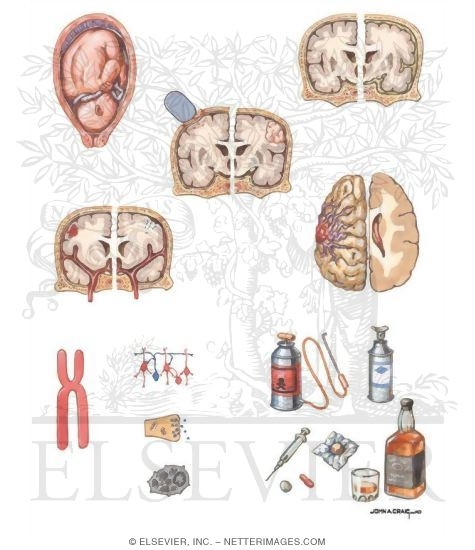 main causes of seizures main causes of seizures