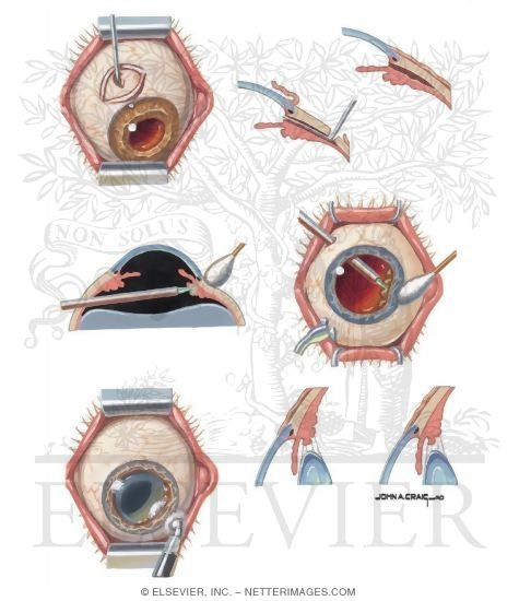 Watermarked preview of unlabeled image: Surgical Management