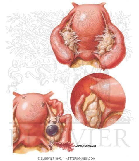 Watermarked preview of unlabeled image: Tubal Abnormalities