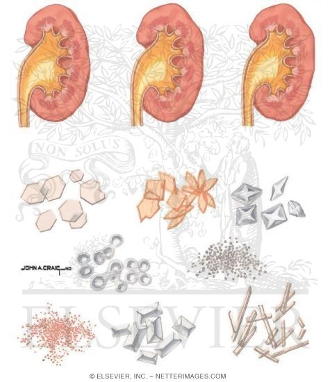 Watermarked preview of unlabeled image: Formation of Urinary Calculi